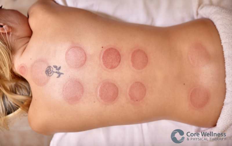 Back with cupping therapy marks